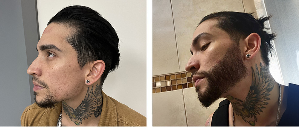 Beard hair transplant Before and After