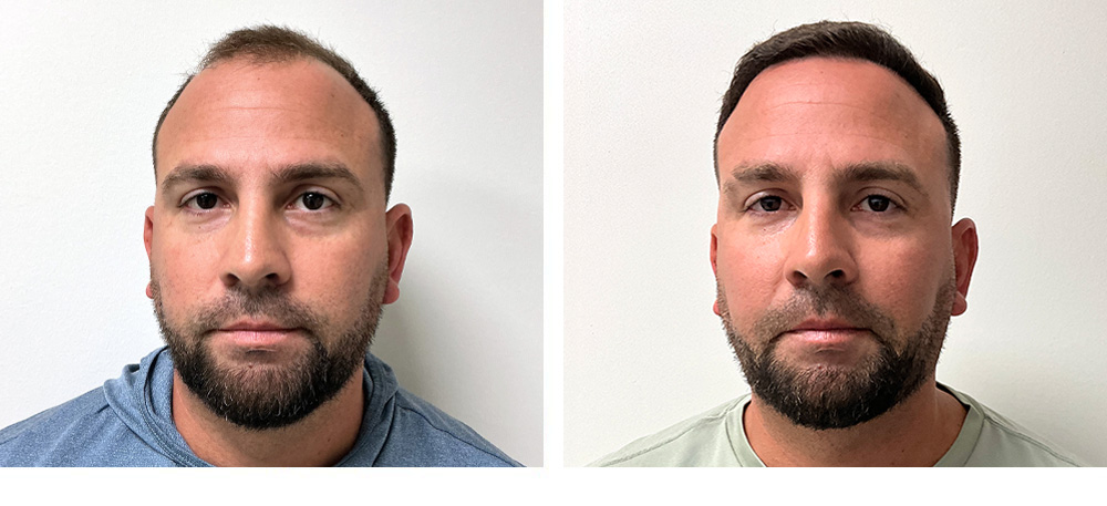 hair Transplant Before and After