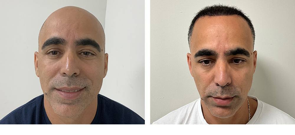 Hair Transplant Before and After in Miami