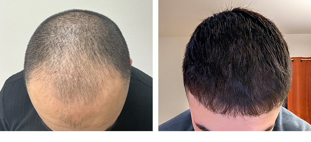 Hair Transplant Before and After
