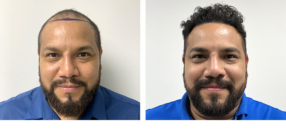 Hair Transplant Before and After