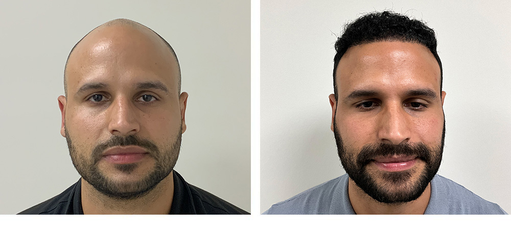 Hair Transplant Before and After