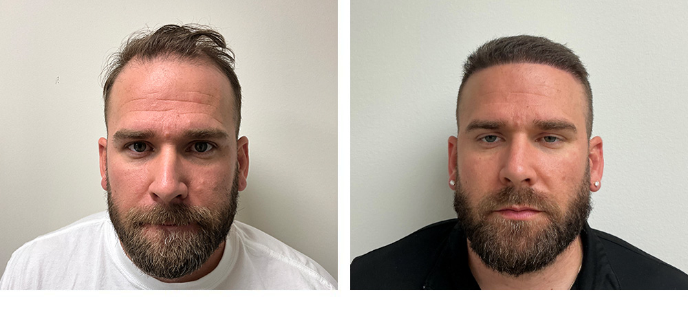 Hair Transplant Before and After