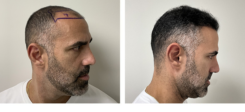 Hair Transplant Before and After in Miami