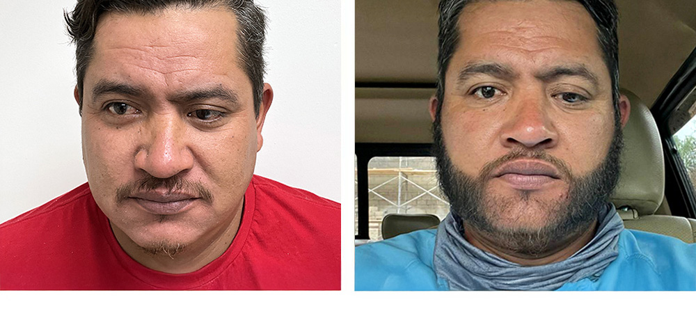 Beard Restoration Before and After