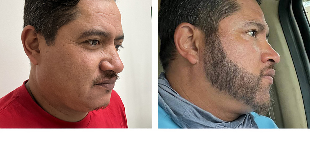 Beard Restoration Before and After