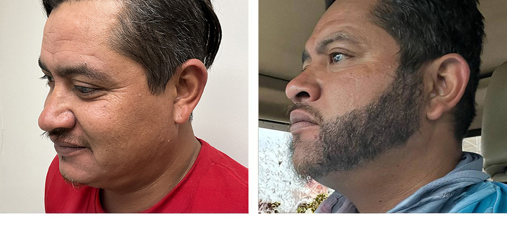 Beard Restoration Before and After