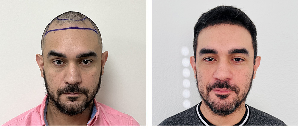 Hair Restoration before and after