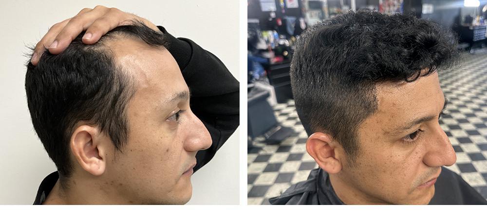 Hair Transplant Before and After