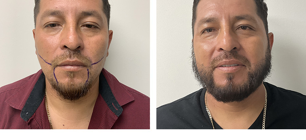 Beard Hair Transplant Before and After