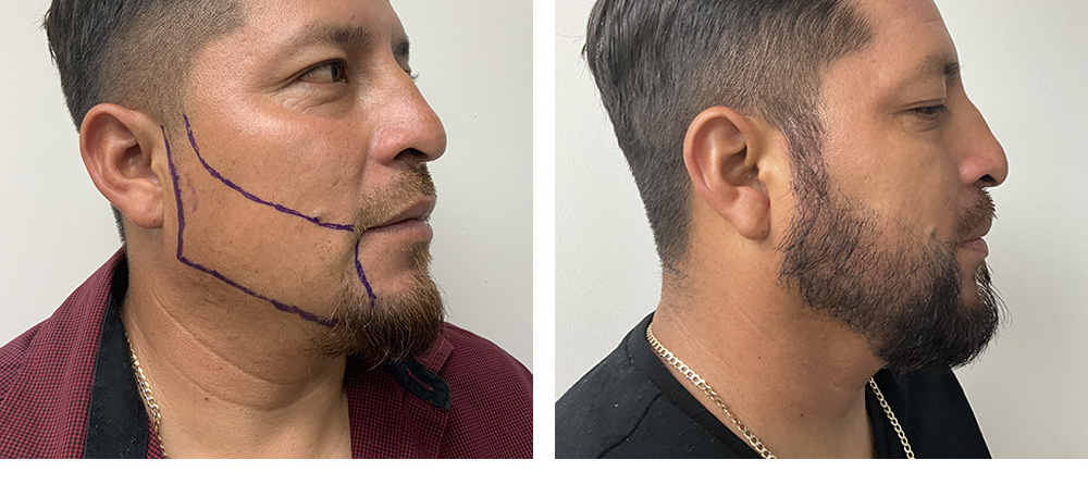 Beard Hair Transplant Before and After