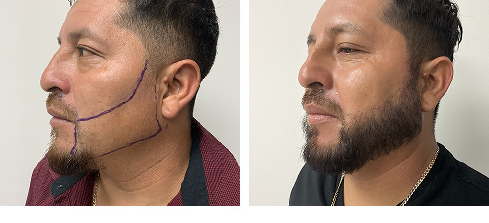 Beard Hair Transplant Before and After