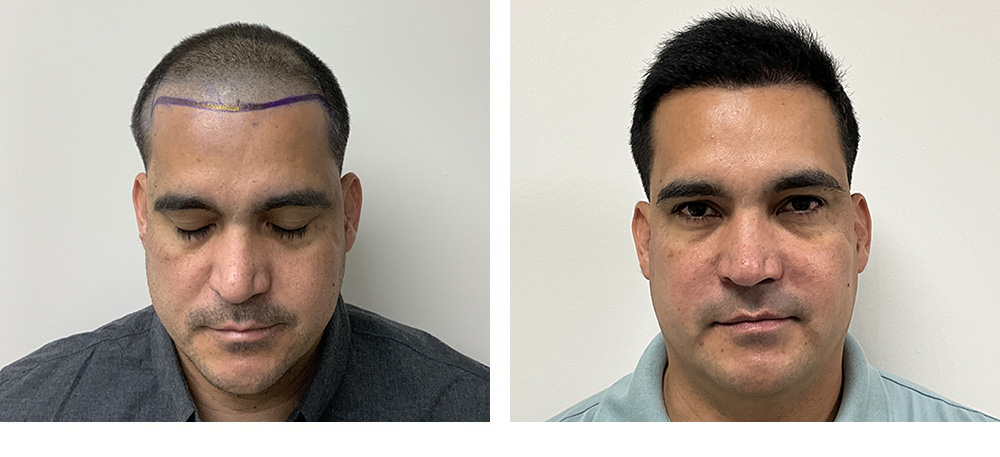 Hair Transplant before and after