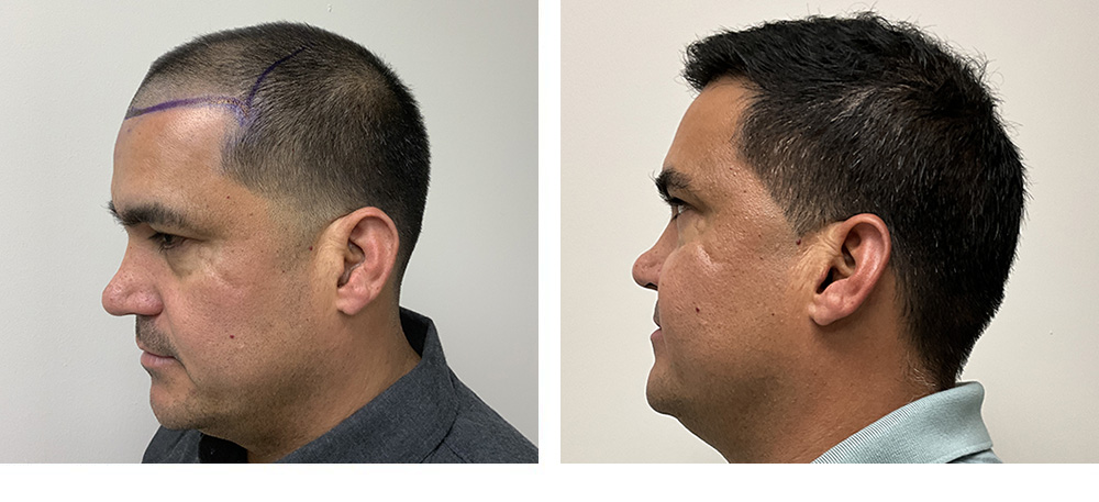 Hair Transplant before and after