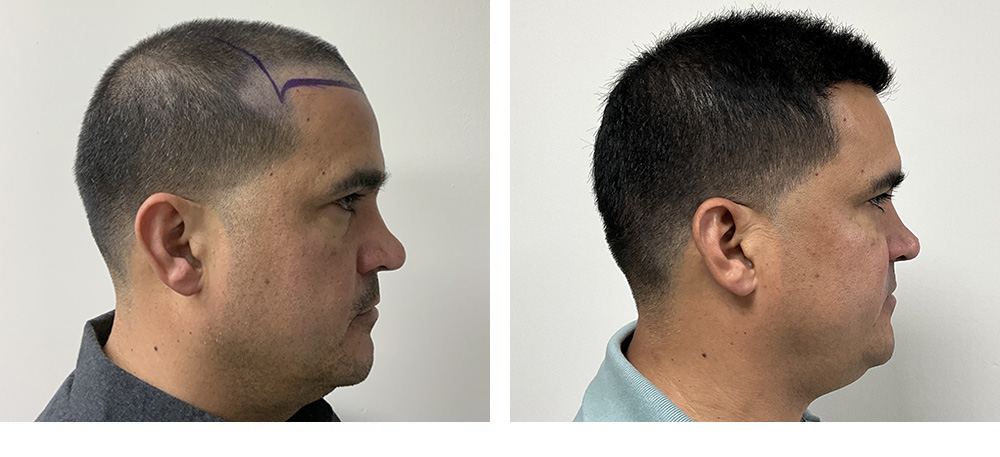 Hair Transplant before and after