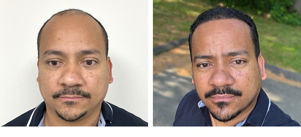 Hair Transplant before and after