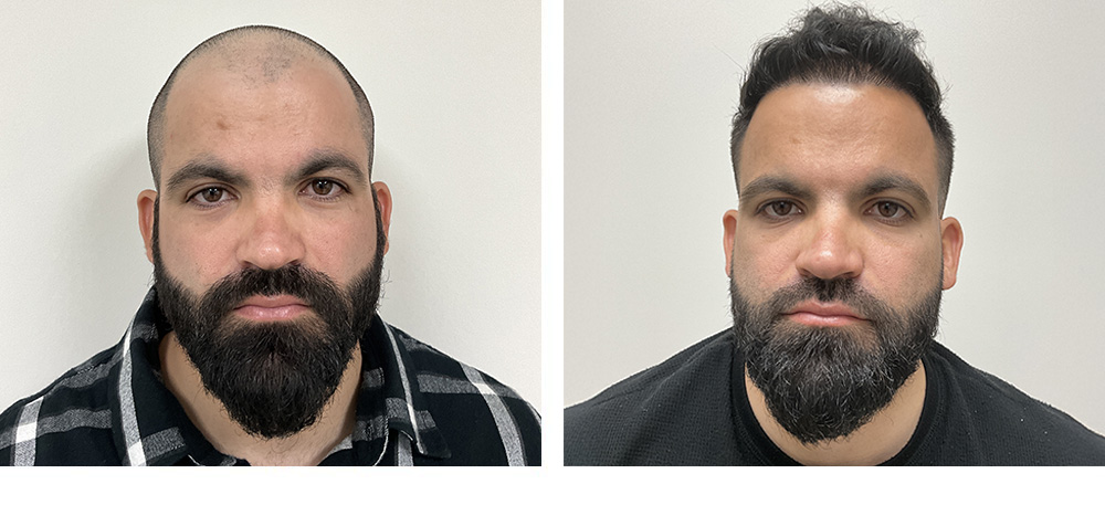 Hair Transplant Before and After