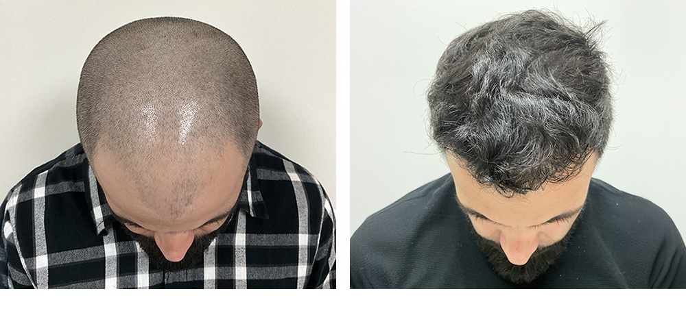 Hair Transplant Before and After