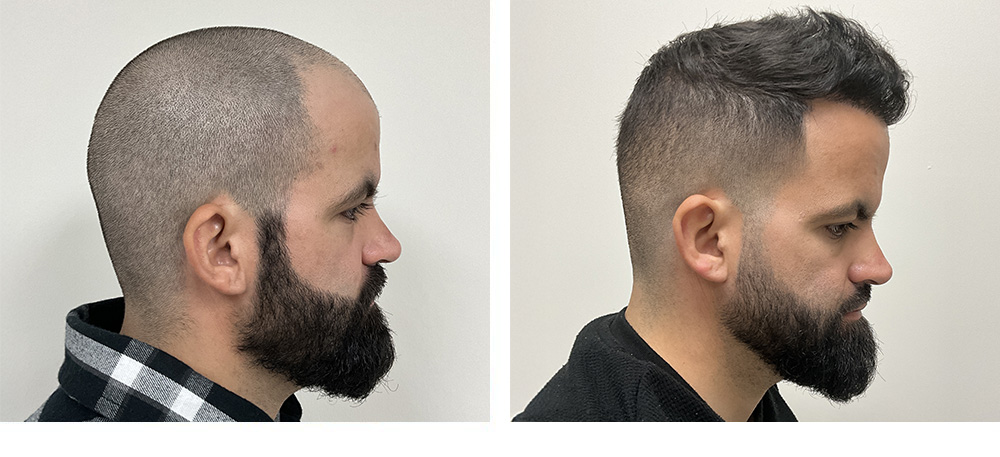 Hair Transplant Before and After
