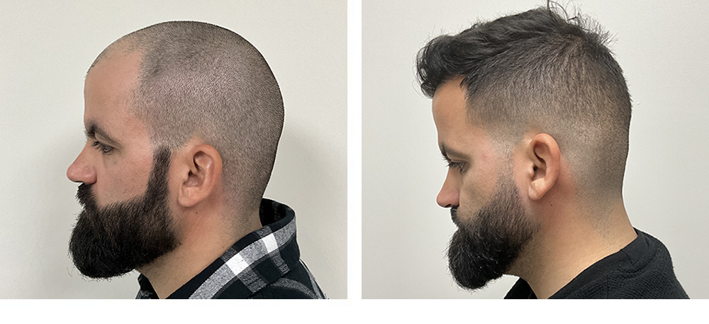 Hair Transplant Before and After