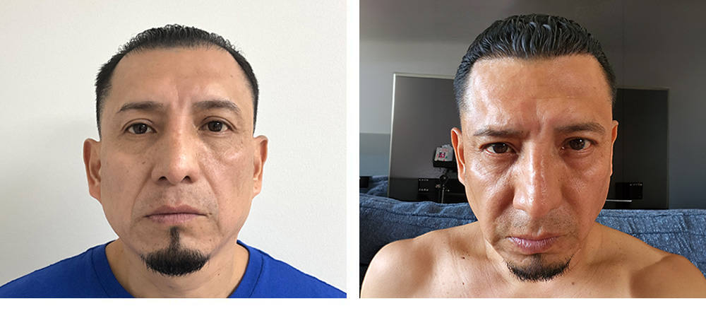 Hair Transplant Before and After