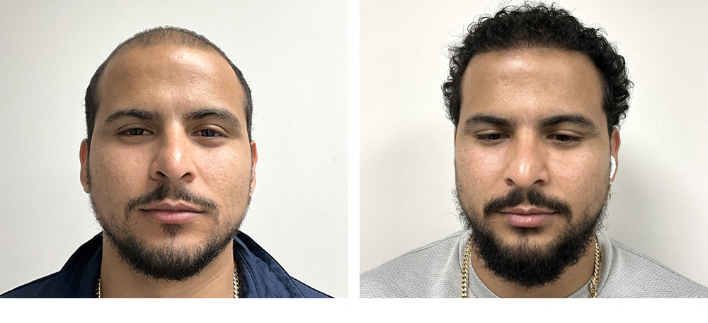 Hair Transplant Before and After