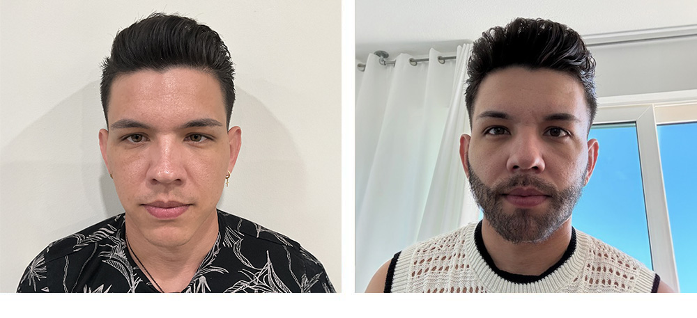 Beard Restoration before and after