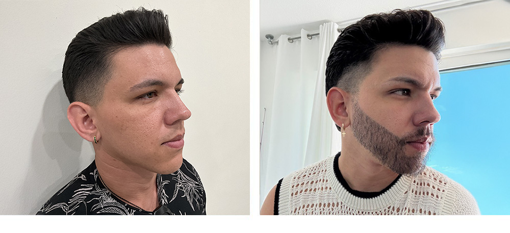 Beard Restoration before and after