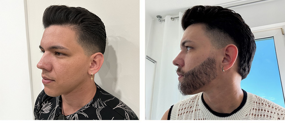 Beard Restoration before and after