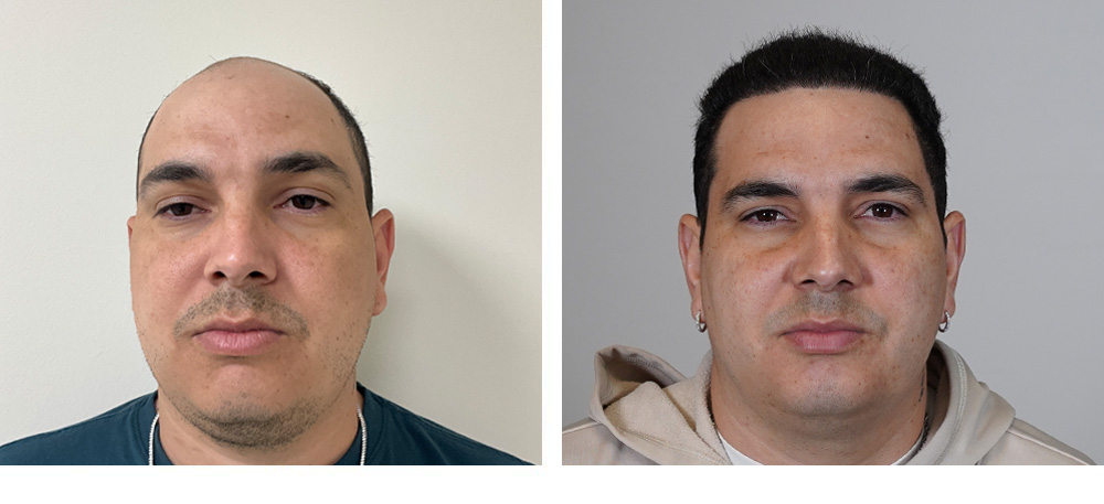 Hair Transplant Before and After