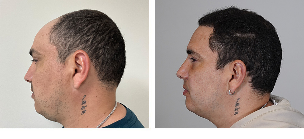 Hair Transplant Before and After
