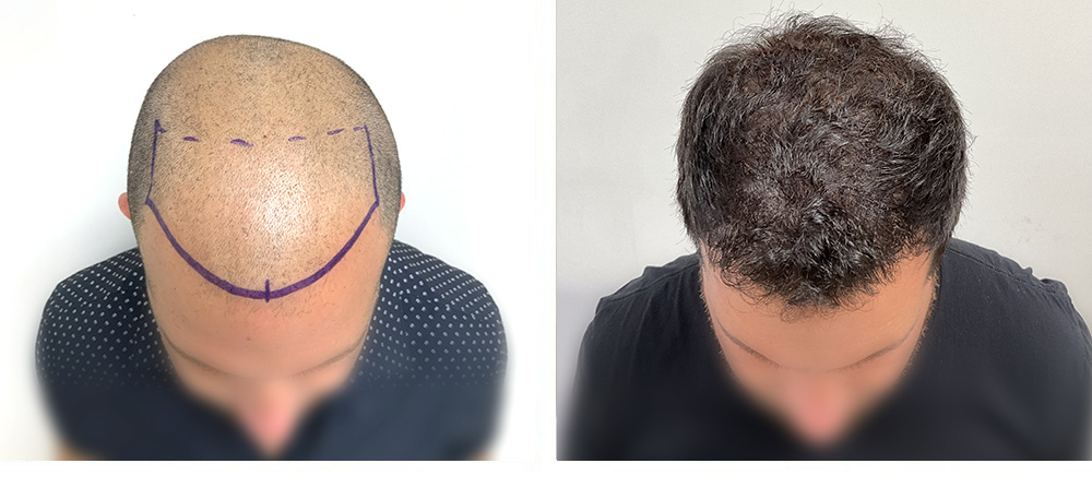 Hair Transplant before and after