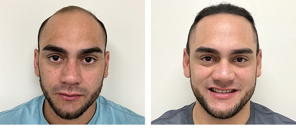 Hair Transplant Before and After