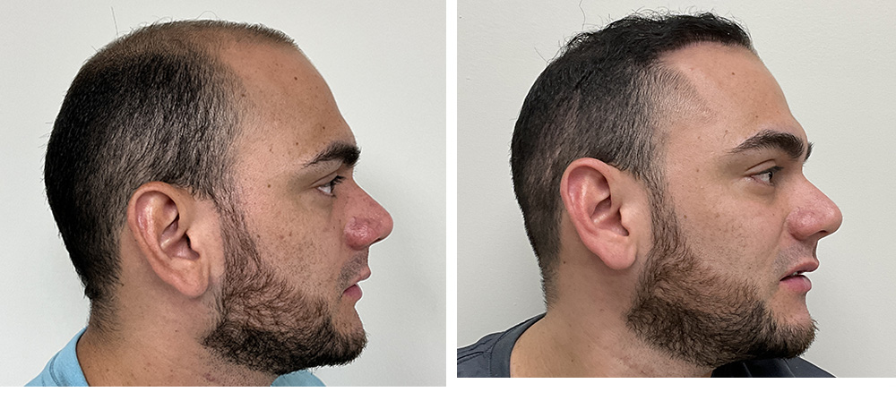 Hair Transplant Before and After