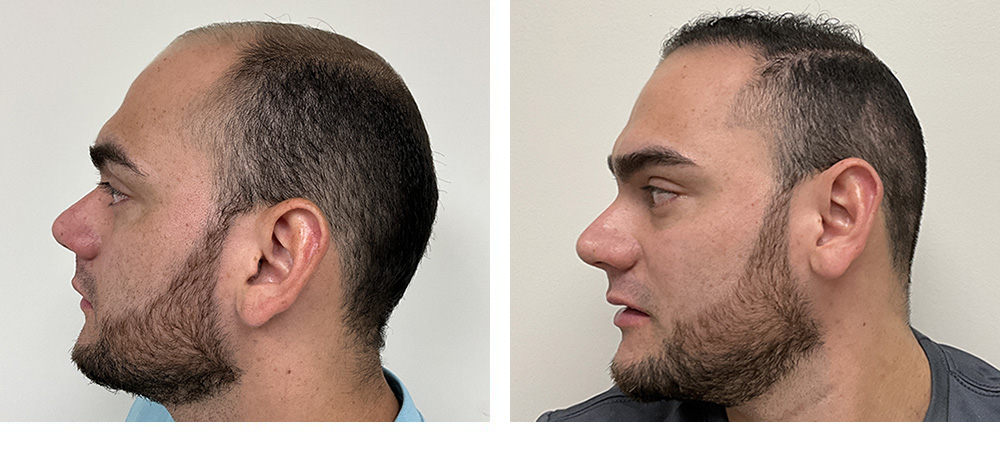 Hair Transplant Before and After
