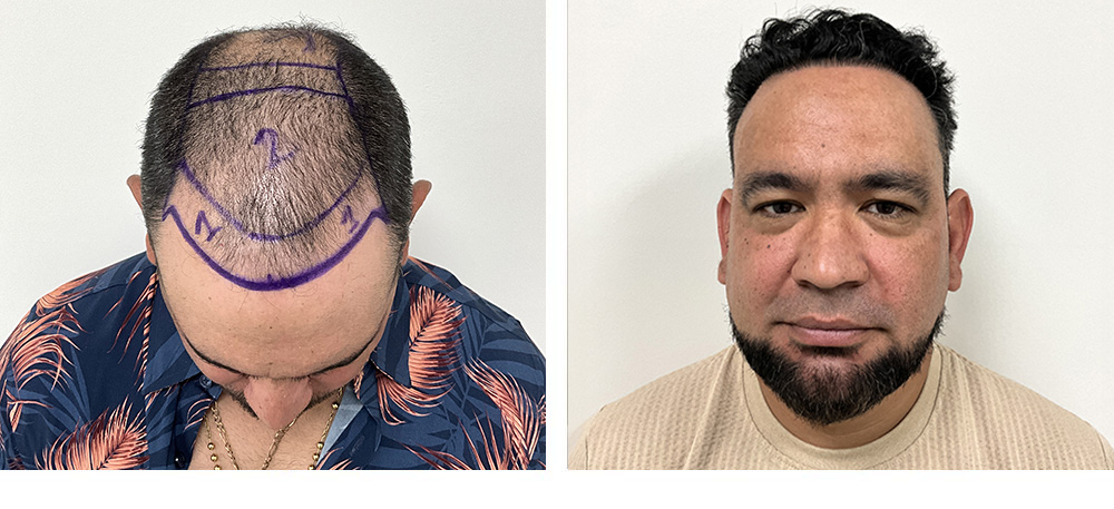 Hair Restoration Before and After in Miami