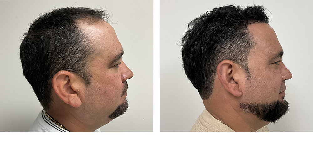 Hair Restoration Before and After in Miami