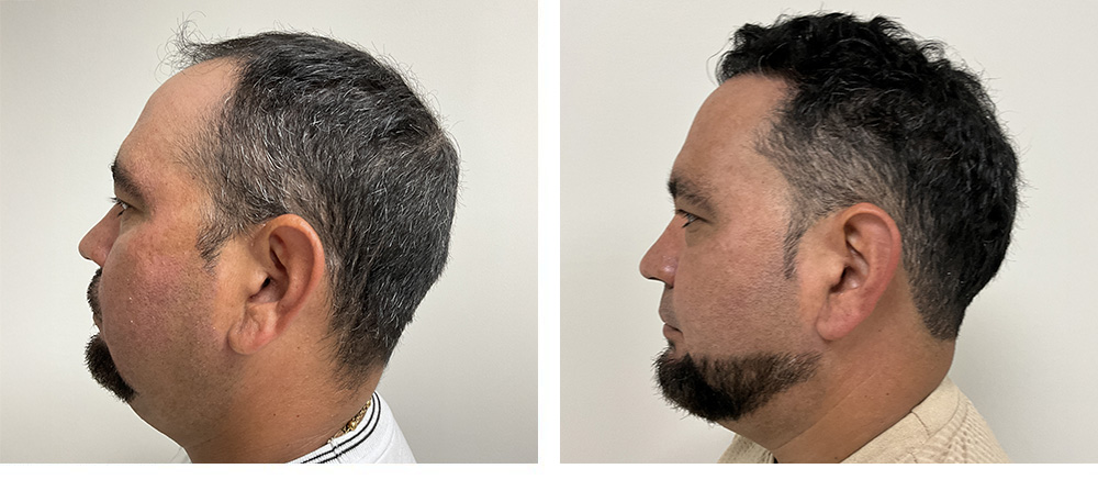 Hair Restoration Before and After in Miami