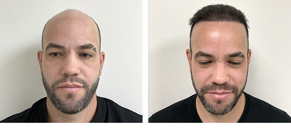 Hair Transplant Before and After