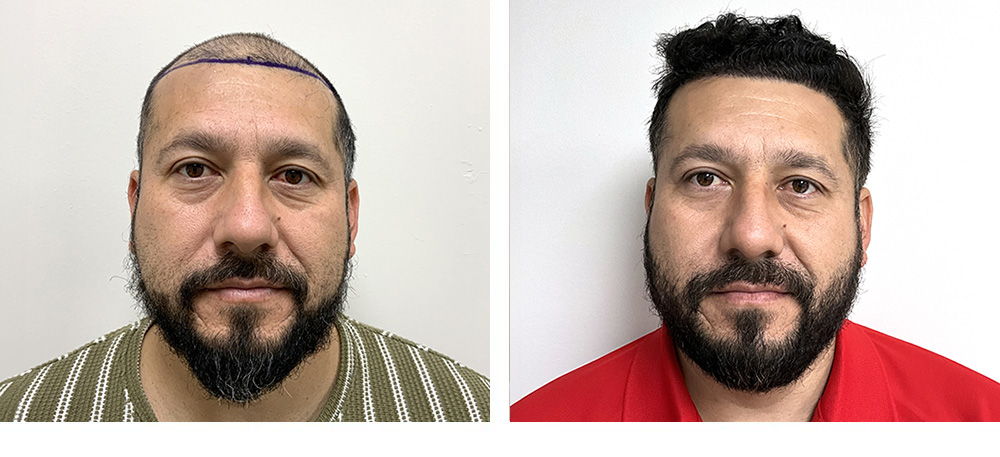 Hair Restoration Before and After
