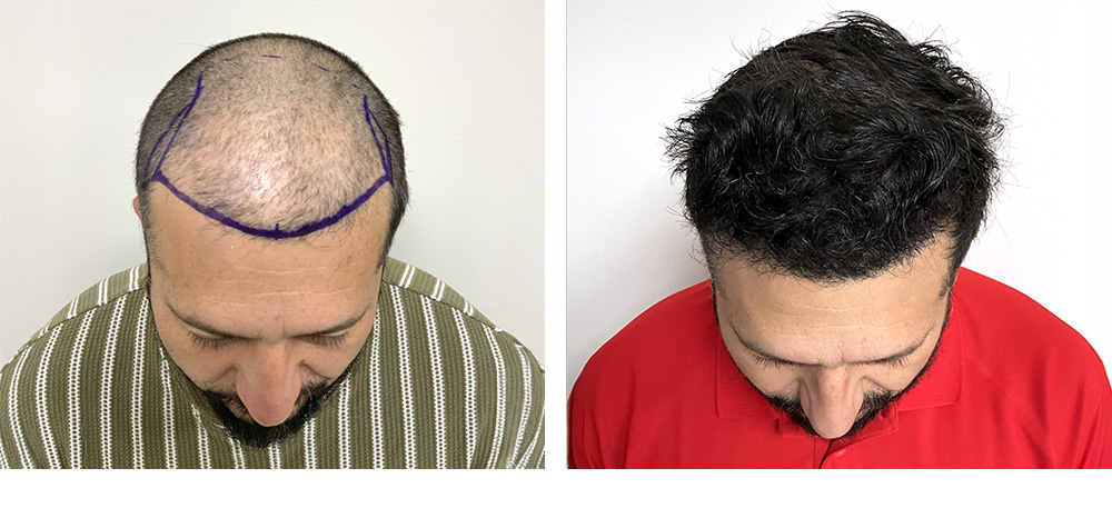 Hair Restoration Before and After