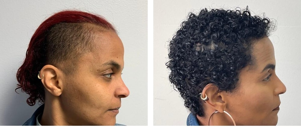 Hair Restoration Results Before and After