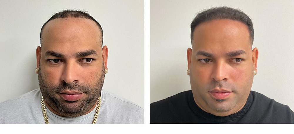 Hair Transplant Before and After