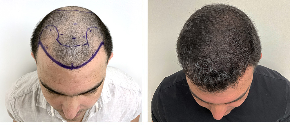 Hair Transplant Before and After