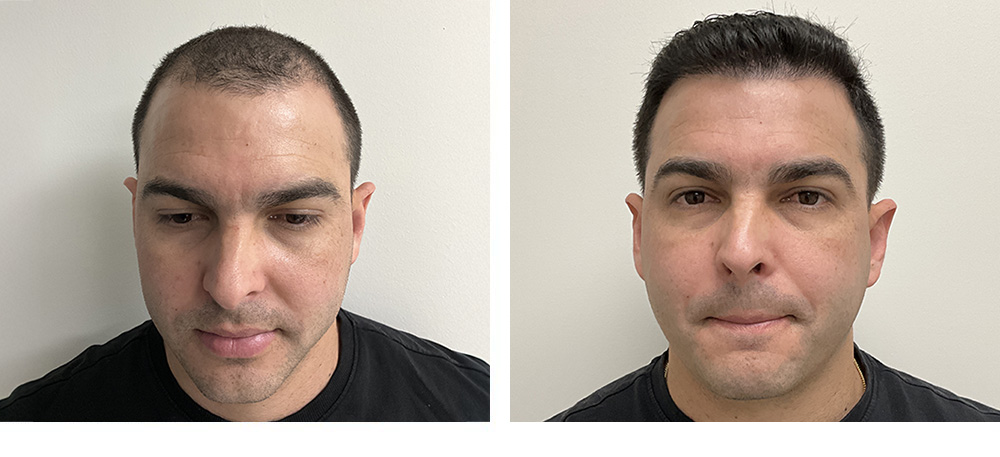 Hair Transplant Before and After 