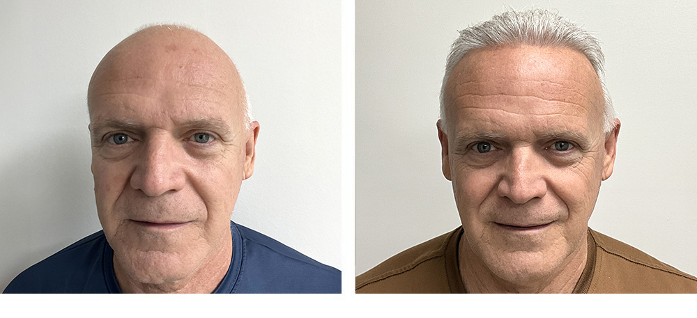 Hair Restoration results before and after