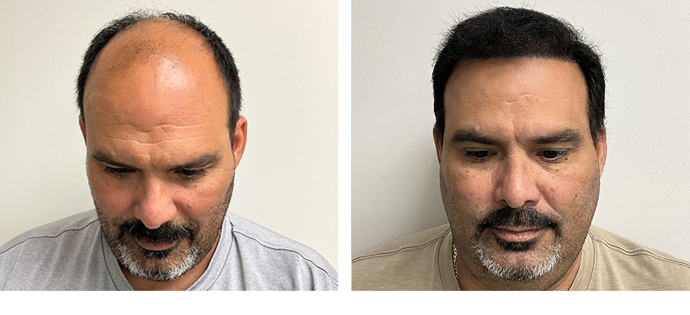 Hair restoration results Before and After