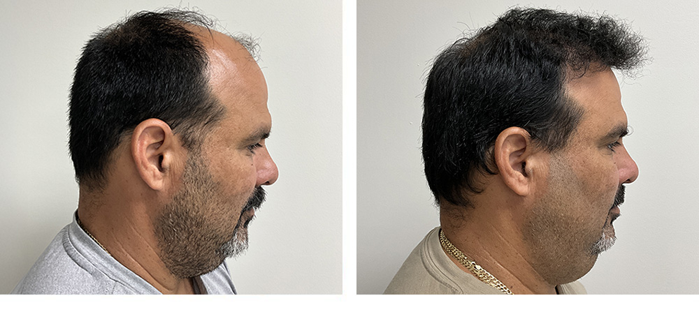 Hair restoration results Before and After