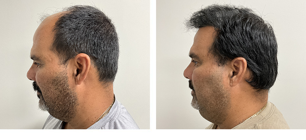 Hair restoration results Before and After