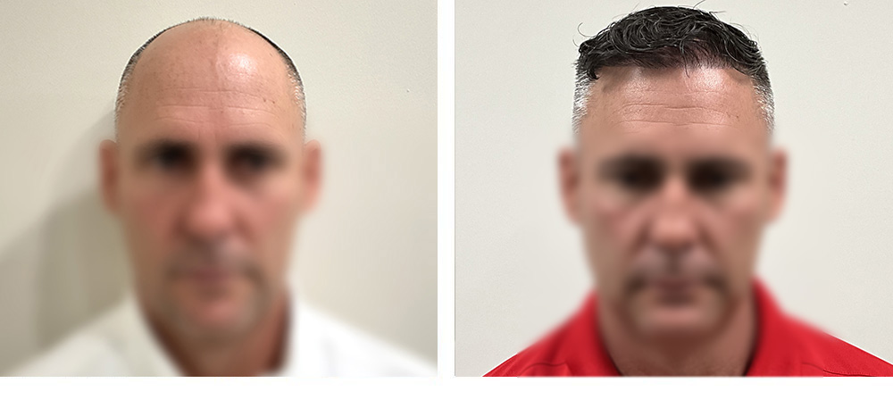 Hair Transplant Before and After